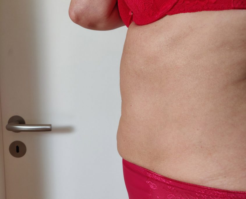 Kryolipolyse Behandlung: nachher