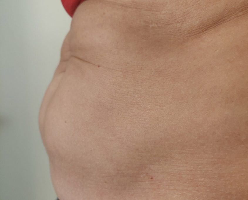 Kryolipolyse Behandlung: vorher